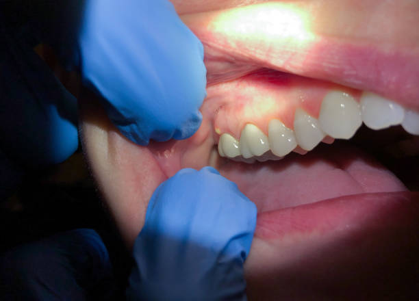 Best Knocked-Out Tooth Emergency  in Shelter Island Heights, NY